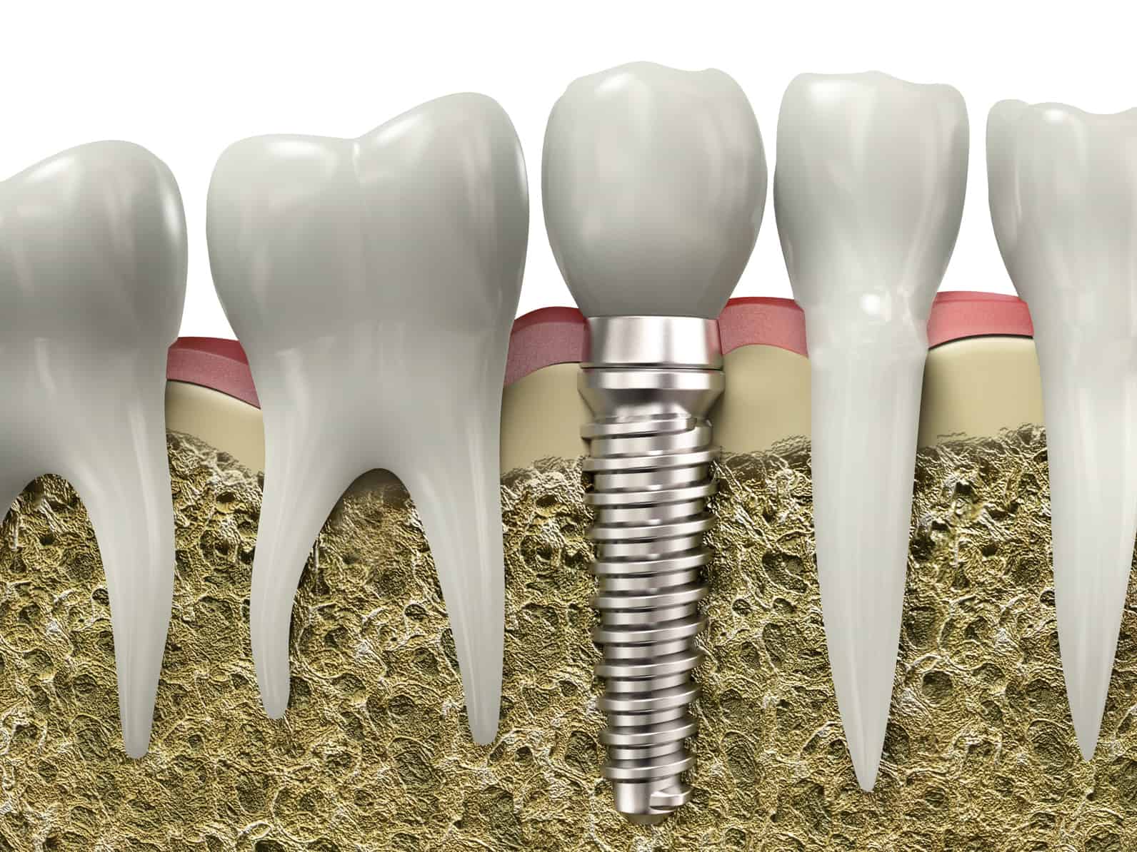 implanty-z-b-w-dentysta-stomatolog-grodzisk-maz-warszawa