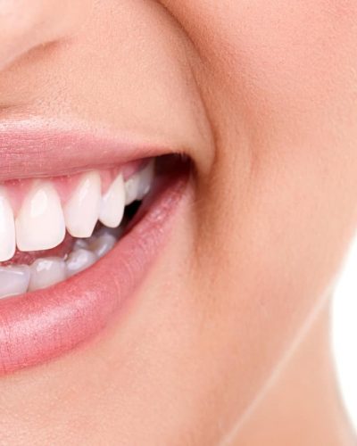 woman teeth and smile. Close up,half with braces